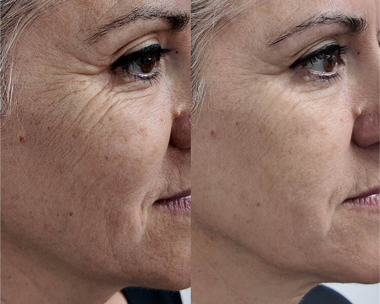 Fusion Exosomes before & after2