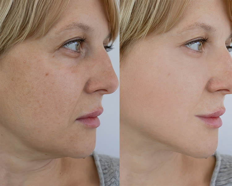 woman double chin before and after treatment