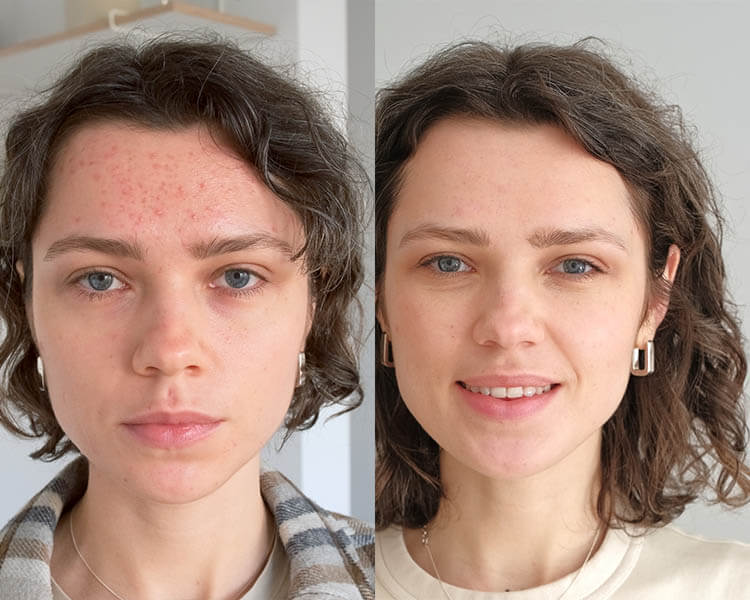 Two close up faces of young beautiful woman show real result before and after acne treatment. Split screen. Home background. Concept  of acne therapy, scars, inflammation on face and problem skin. UGC